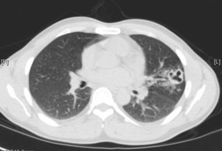 Chest imaging from pulmonary paragonimiasis case