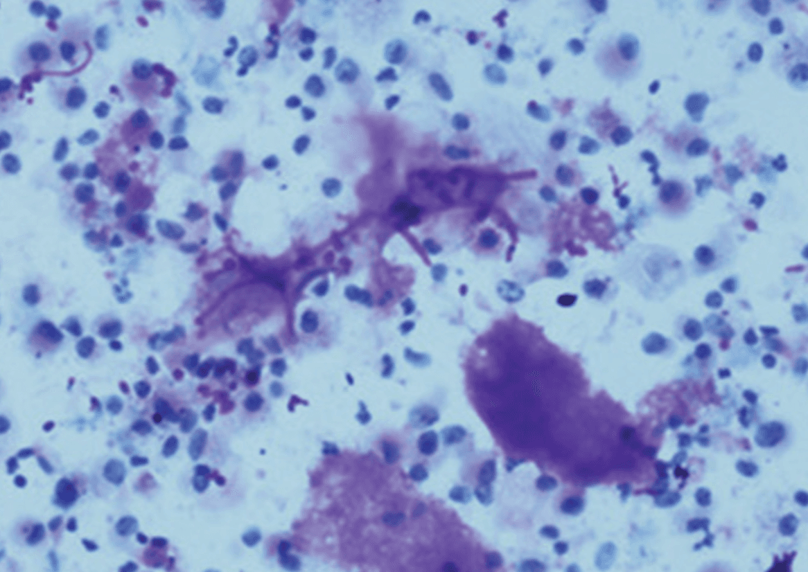 PAS-stained bronchoalveolar lavage specimen