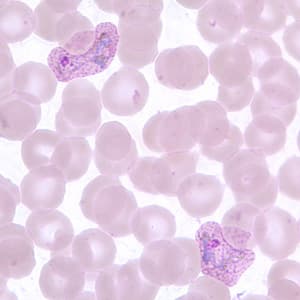 Giemsa-stained thin blood smear showing enlarged erythrocytes with ameboid trophozoites and Schüffner's stippling