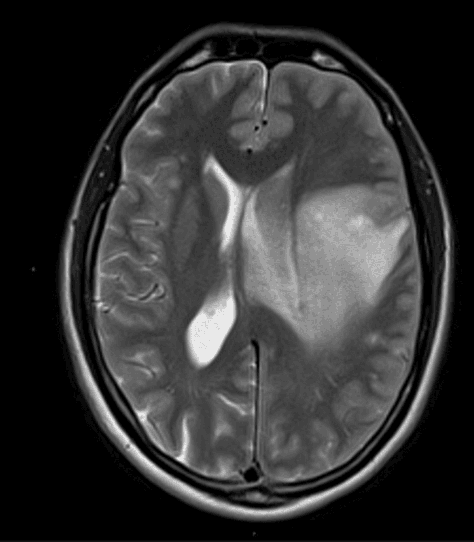 Axial T2-weighted brain MRI showing a large left frontal white matter lesion with surrounding edema, leftward midline shift, and subfalcine herniation