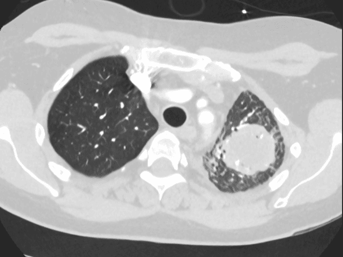 CT chest with contrast showing a 4.2 cm heterogeneous mass in the left upper lobe with mediastinal lymphadenopathy in a heart transplant recipient