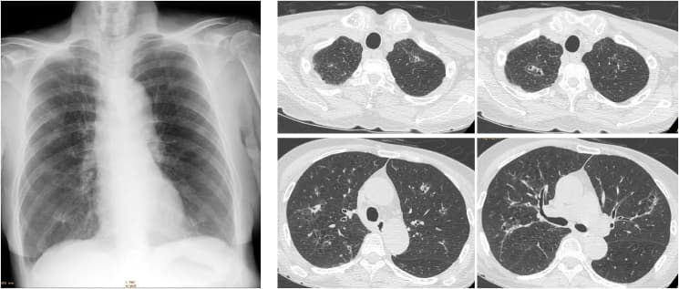 Chest CT showing small thin-walled cavitary nodules surrounded by ground-glass opacity