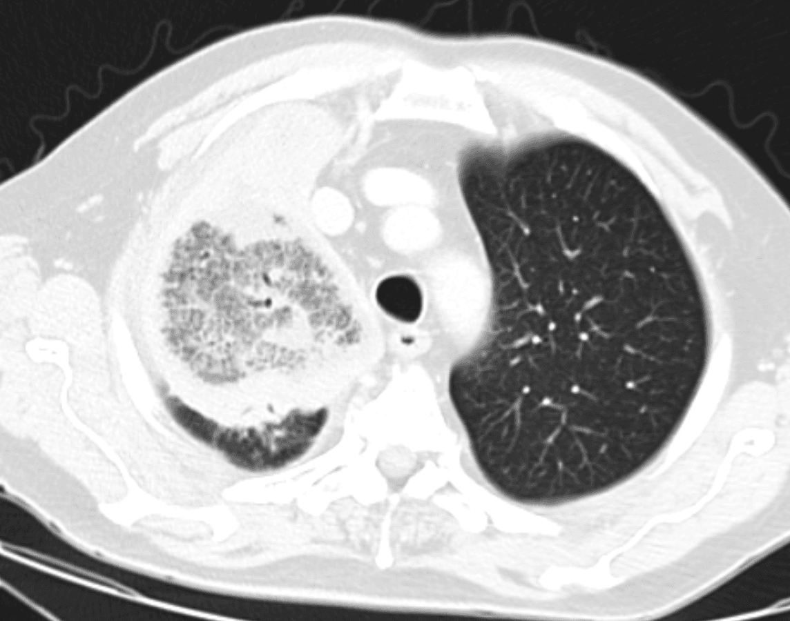 Axial CT chest demonstrating a right upper lobe reverse halo sign