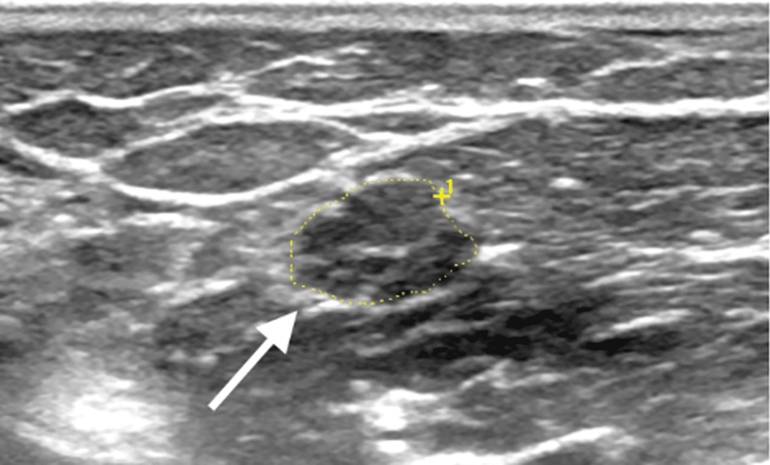 High-resolution ultrasound of the left ulnar nerve at the cubital tunnel demonstrating fusiform enlargement with loss of normal fascicular echotexture