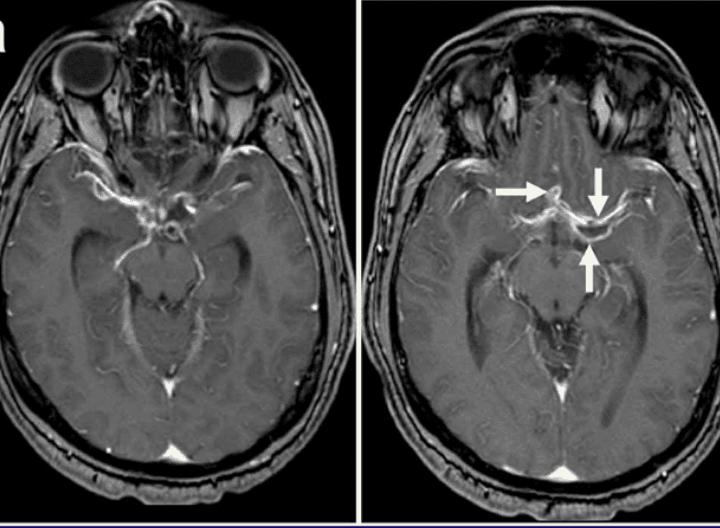 MRI brain showing subarachnoid cystic lesions with inflammatory enhancement