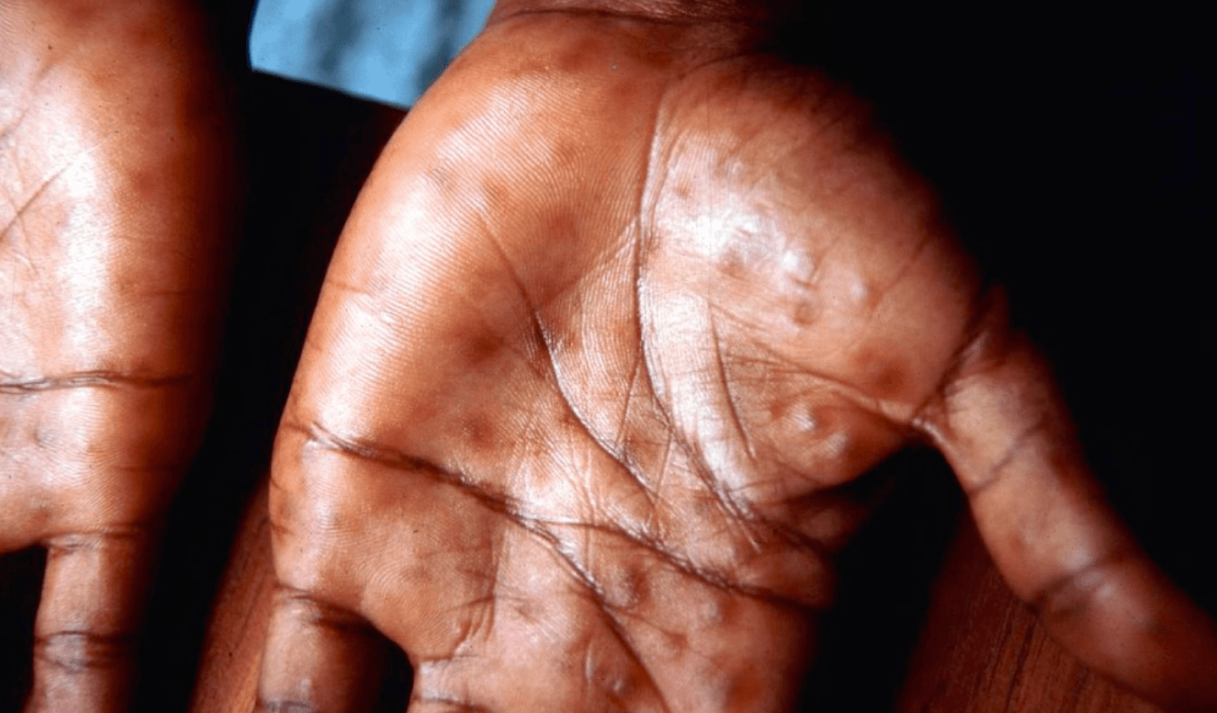 Palmar rash of secondary syphilis: discrete copper-colored maculopapular lesions on the palm