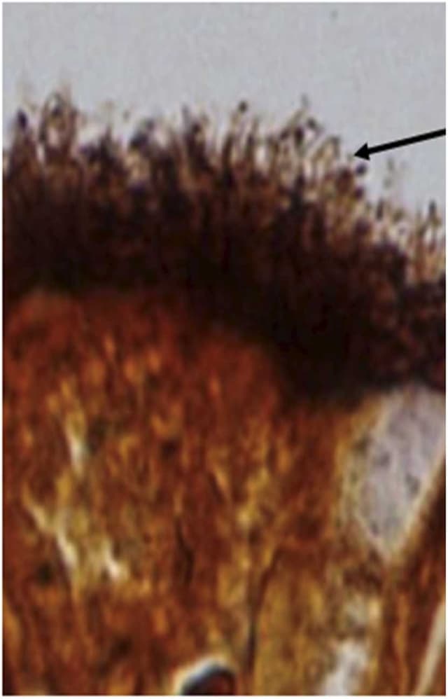 Silver stain highlighting spirochetes lining the colonic surface