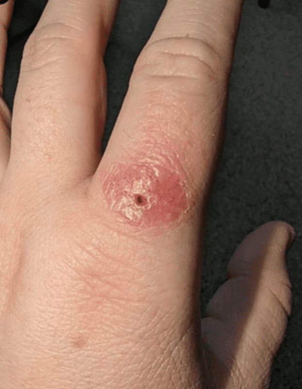 Ulcerated erythematous lesion over the right index finger