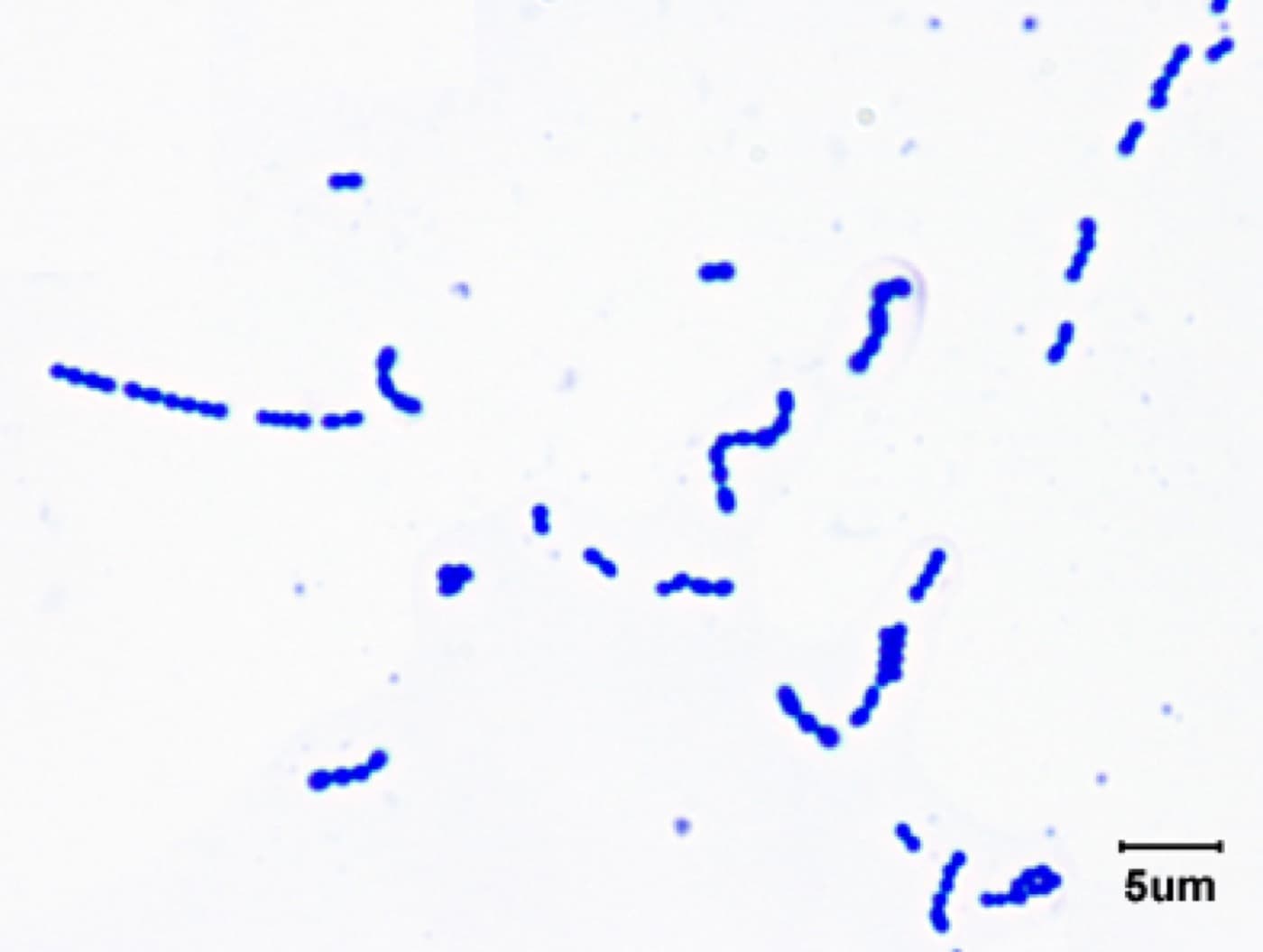 Gram stain of the positive blood culture showing gram-positive cocci in chains