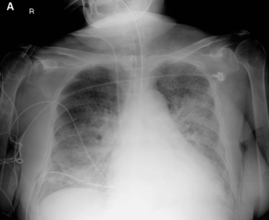 Chest X-ray with bilateral patchy infiltrates in Strongyloides hyperinfection