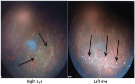 Bilateral fundus photographs in ocular syphilis showing inferior vitreous inflammatory snowballs