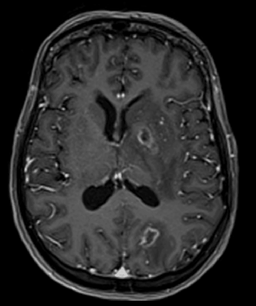 MRI brain with gadolinium showing ring-enhancing lesions in the basal ganglia