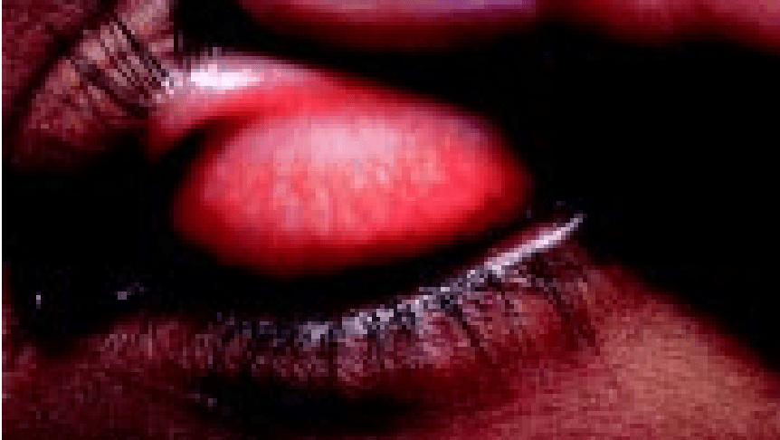 Follicular trachoma of the upper tarsal conjunctiva after upper lid eversion