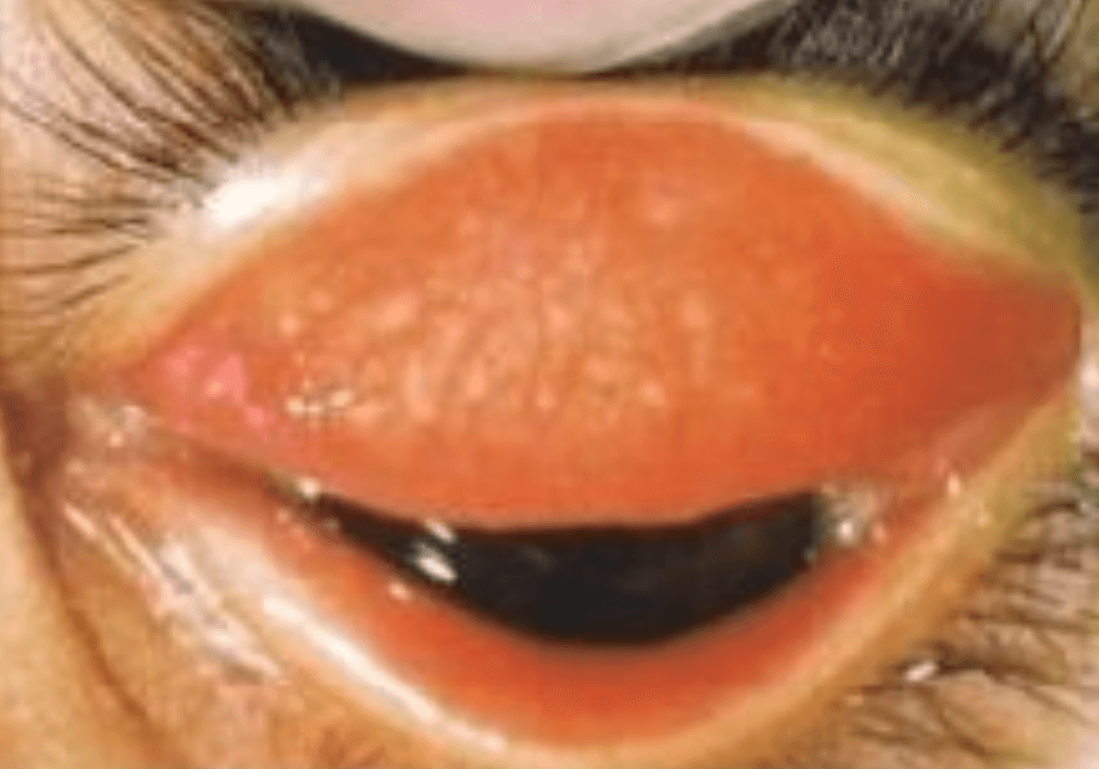 Slit-lamp image of everted upper eyelid showing follicles on the tarsal conjunctiva