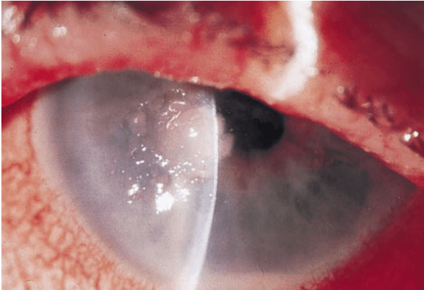 Slit-lamp examination showing a central corneal ulcer with dense infiltrate and inferior hypopyon