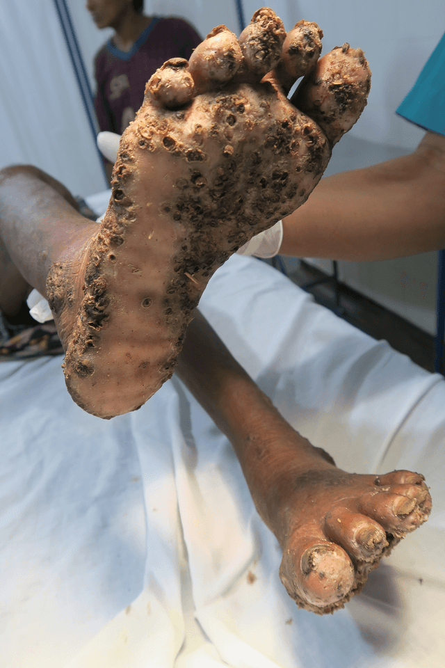 Tungiasis lesions involving the feet