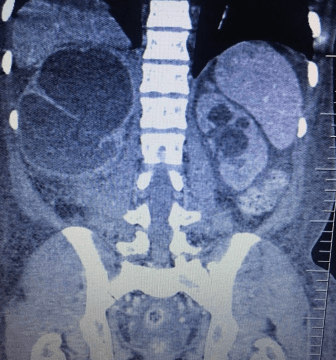 CT abdomen and pelvis demonstrating massive right-sided hydroureteronephrosis