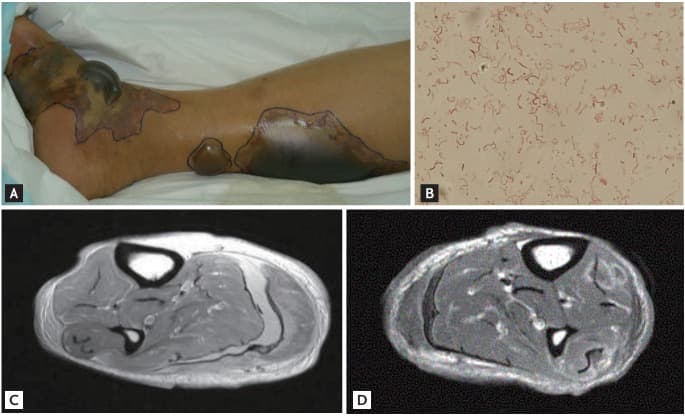 Clinical photograph showing hemorrhagic bullae and ecchymoses on the lower extremity, Gram stain of aspirated fluid, and MRI of the affected limb