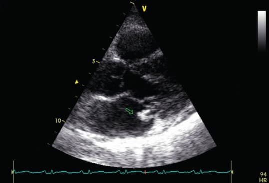 Transthoracic echocardiogram showing a mobile echogenic vegetation attached to the posterior mitral valve leaflet