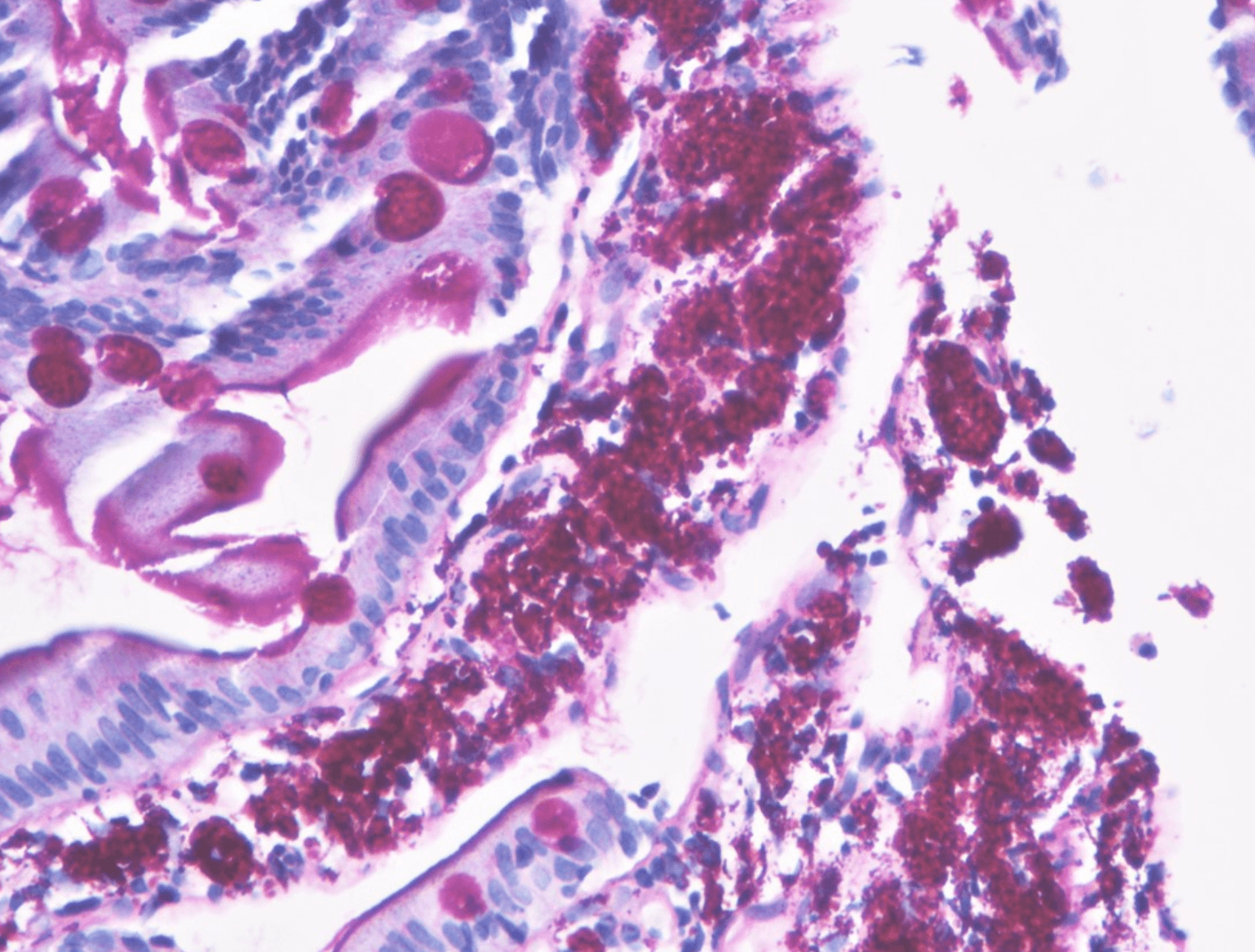 PAS stain of duodenal biopsy demonstrating foamy macrophages in the lamina propria filled with PAS-positive, diastase-resistant granular material