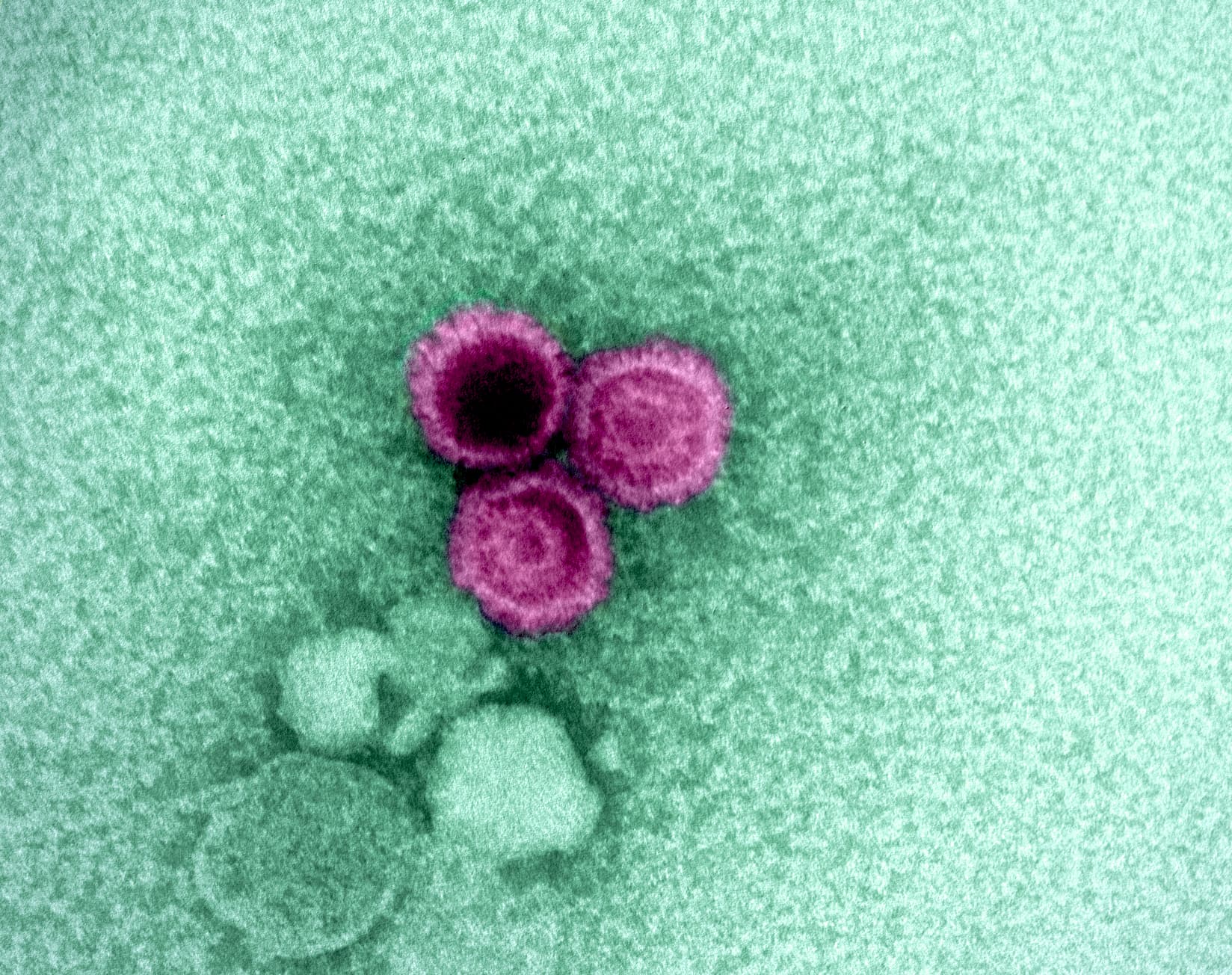 Electron micrograph showing three Epstein-Barr virus particles colorized pink.