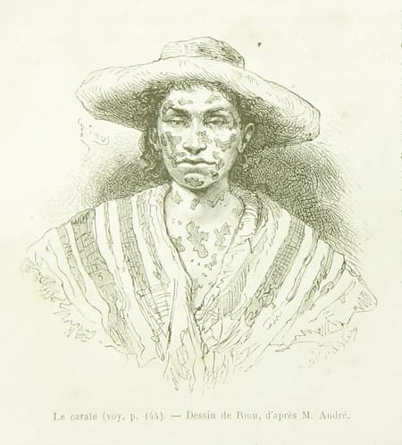 An 1869 illustration titled 'El carate' by Édouard André and Édouard Riou, showing a person being examined for pinta, the painted disease. It is one of the earliest visual records of the disease.