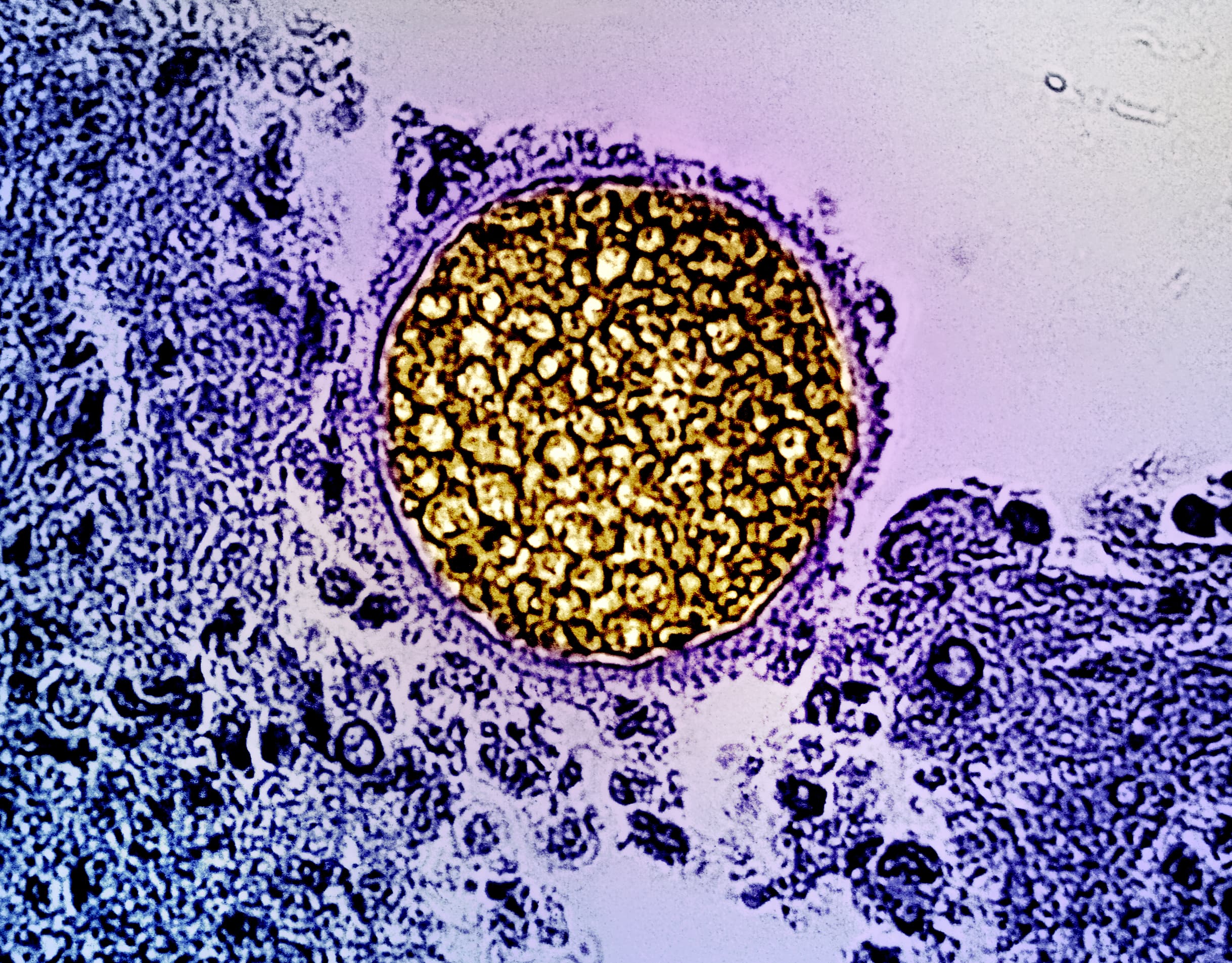 A Coccidioides spherule in tissue, the large round body filled with endospores. This is the tissue form that Alejandro Posadas saw under his microscope in 1892 and mistook for a protozoan parasite.