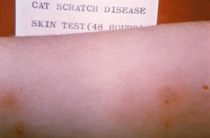 Forearm skin-test reaction after Bartonella henselae antigen injection, used as an illustrative clinical microbiology image rather than a portrait.