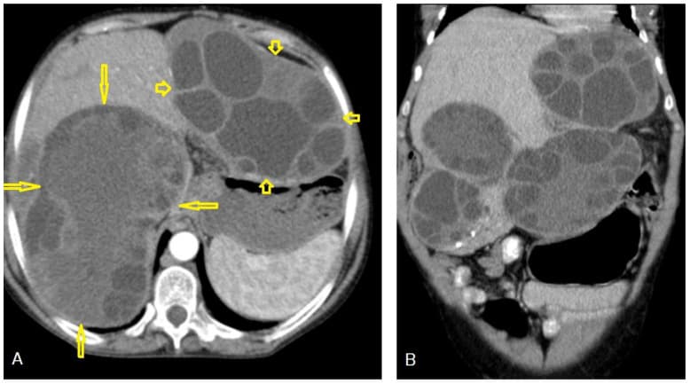 Contrast-enhanced CT of the abdomen showing a large multiloculated hepatic cyst with peripheral daughter cysts