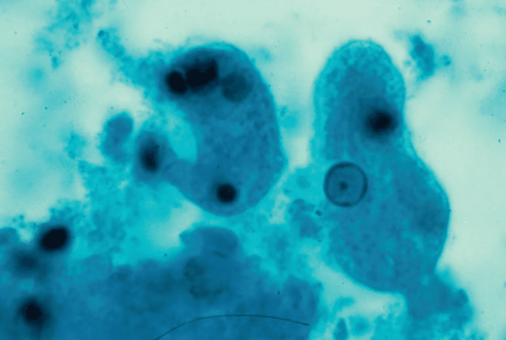 Trophozoite of Entamoeba histolytica showing erythrophagocytosis — ingested red blood cells visible within the cytoplasm