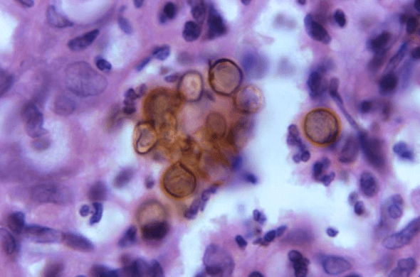 Histopathology showing brown thick-walled muriform sclerotic bodies (Medlar bodies) within the dermis, the pathognomonic finding of chromoblastomycosis