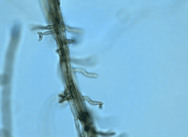 Microscopic morphology of Fonsecaea pedrosoi showing dark brown septate hyphae with conidia produced by multiple conidiation types