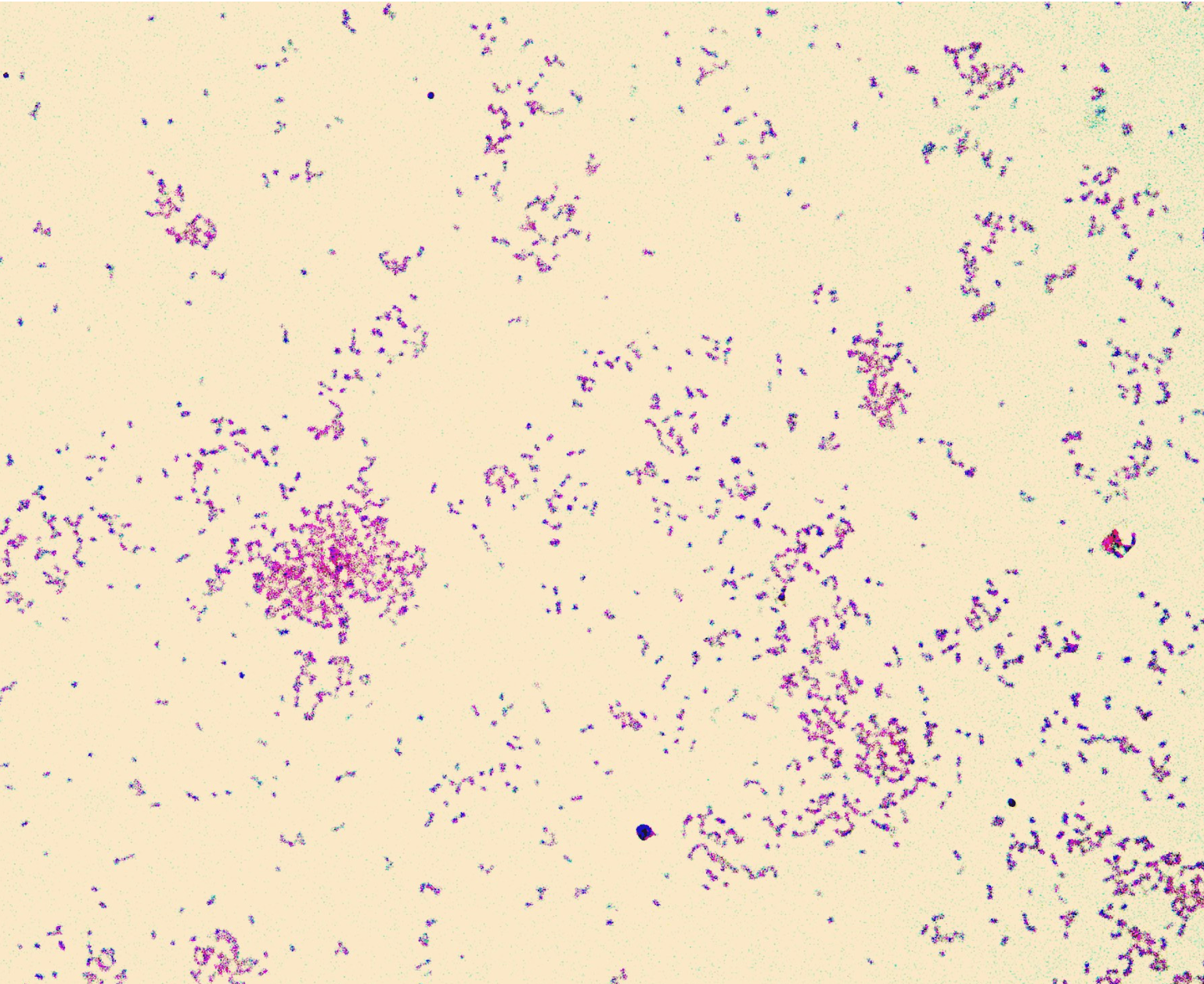CSF Gram stain showing small pleomorphic gram-negative coccobacilli consistent with Haemophilus influenzae