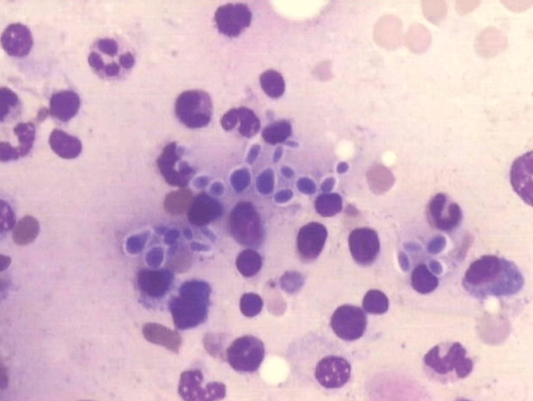 Bone marrow aspirate Wright-Giemsa stain showing small intracellular yeast forms within macrophages