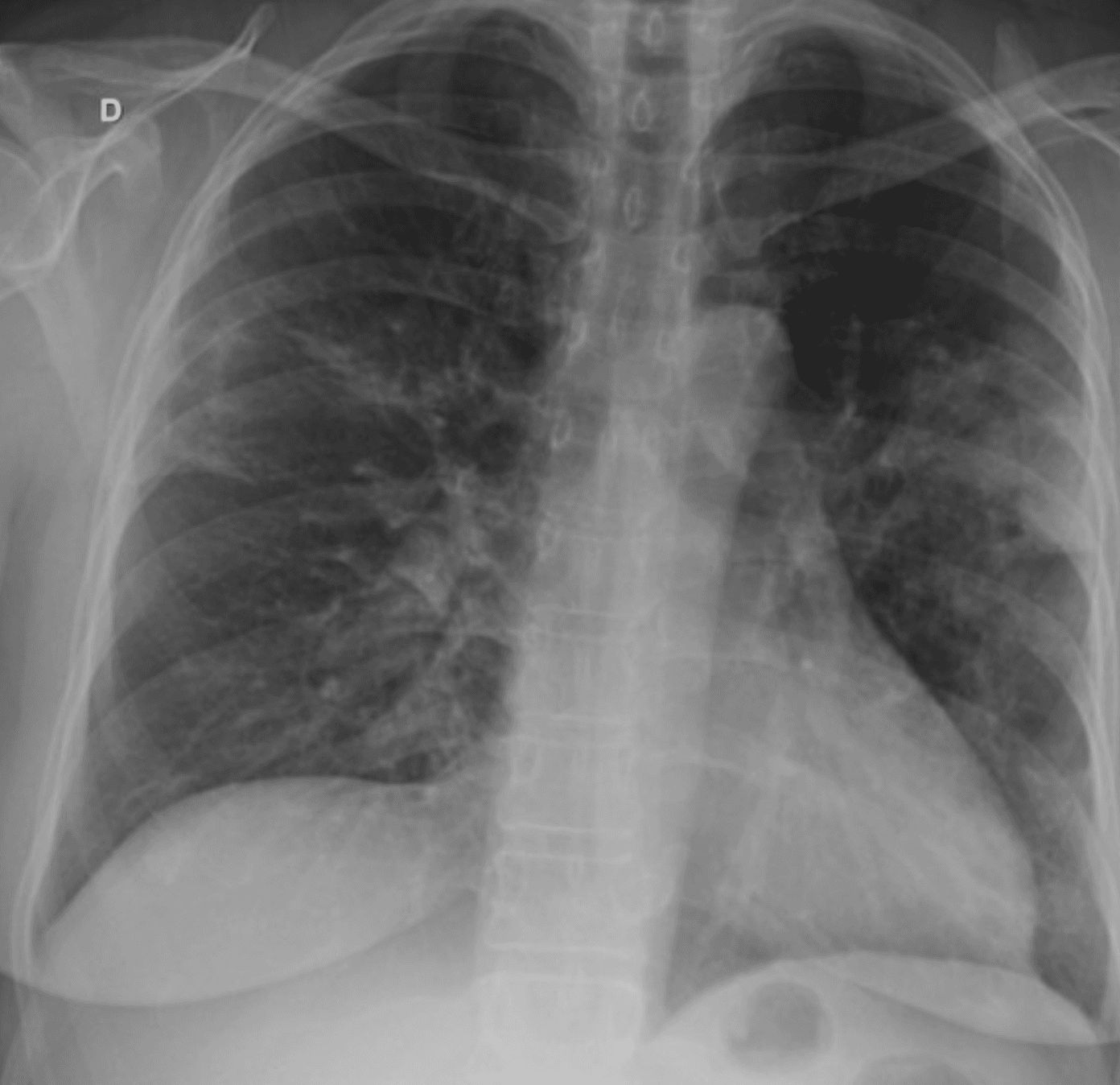 Chest radiograph showing patchy bilateral perihilar and bibasilar airspace opacities in influenza A pneumonia