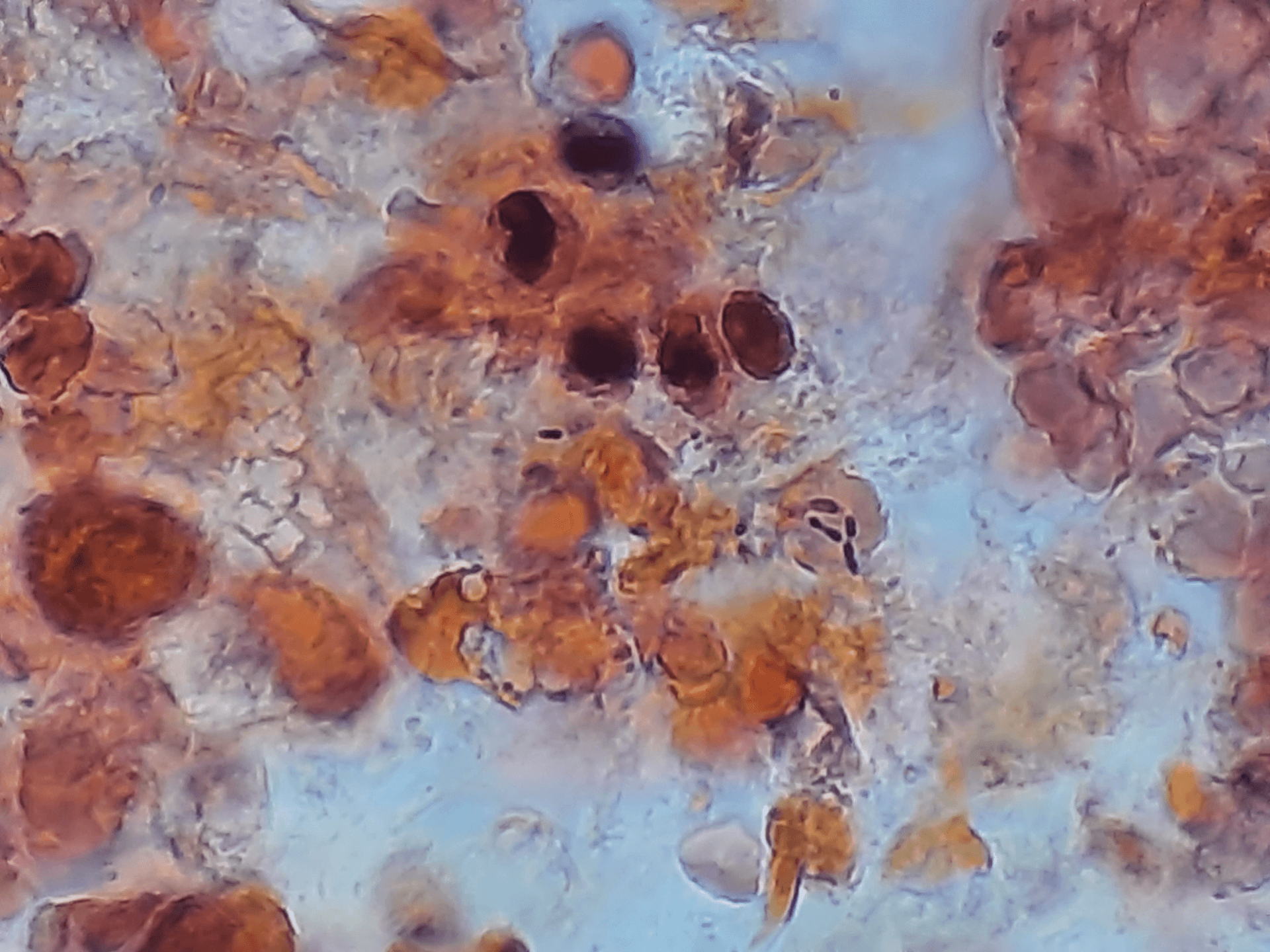 Gram stain prepared from the positive blood culture