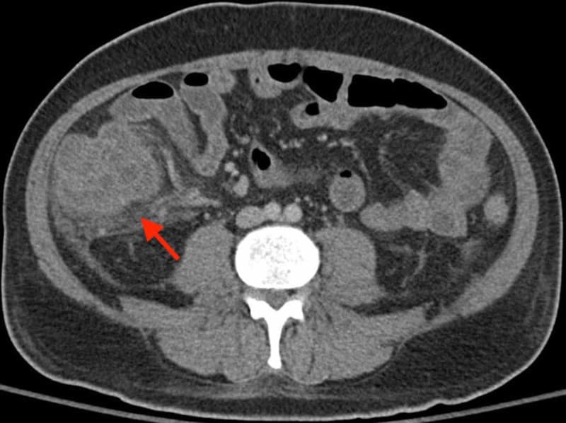 Axial CT abdomen showing marked circumferential wall thickening of the cecum and right hemicolon with peri-colonic inflammatory stranding, consistent with neutropenic enterocolitis