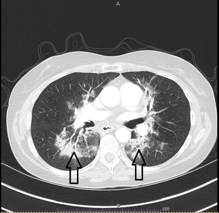 Axial CT chest showing bilateral ground-glass opacities characteristic of checkpoint inhibitor pneumonitis