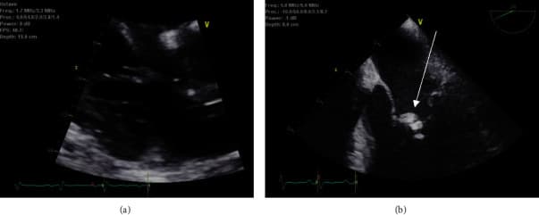 Echocardiogram demonstrating a mobile vegetation on the mitral valve