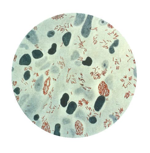 Photomicrograph of Mycobacterium leprae from a lepromatous skin lesion.